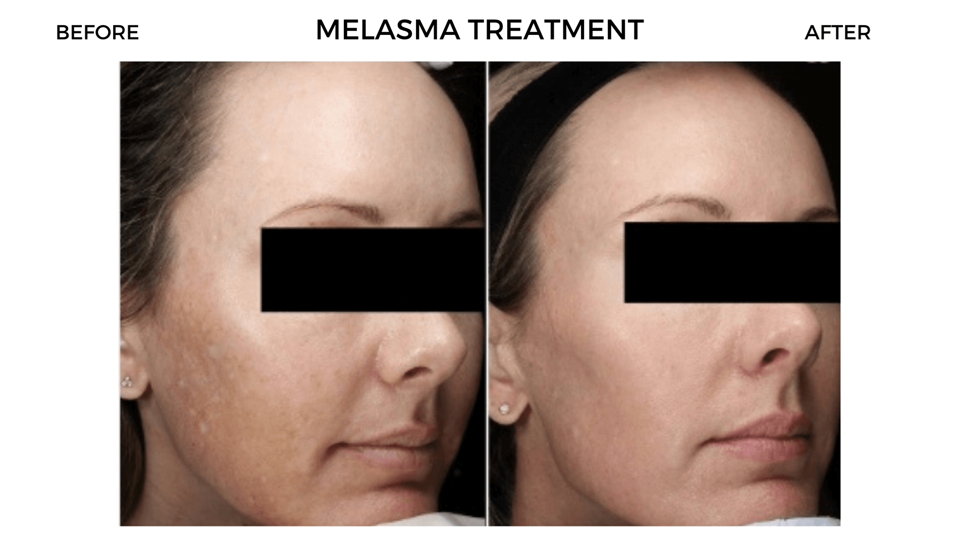 Melasma Treatment